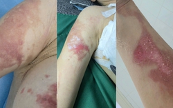 Người phụ nữ tố bị bỏng khi sử dụng dịch vụ tại spa ở Hà Nội