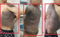 Bé trai mang khối u khổng lồ như "mai rùa", lần đầu tiên đứng thẳng lưng sau 7 năm