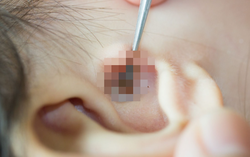 Bé gái 2 tuổi bị bọ chét ký sinh trên màng nhĩ