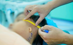 Dị tật tai nhỏ có thể ảnh hưởng đến sức nghe, tâm lý của trẻ