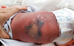 Bé sơ sinh bị bỏng nặng, nhiễm trùng máu khi nằm hơ than cùng mẹ