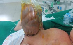 Bé sơ sinh bị ruột treo ngoài thành bụng hiếm gặp