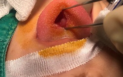 Bị ngã khi cầm que tự chơi, bé 5 tuổi bị dị vật đâm vào trán