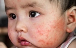 Trẻ sơ sinh bị kê nên tắm lá gì và cách chăm sóc bé nhanh khỏi