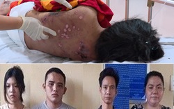 Cô gái bị tra tấn thương tích 96%, bị ép ăn cơm độn ớt bột