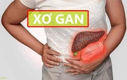 Những ai nên đi xét nghiệm xơ gan?