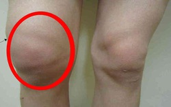 Viêm bao hoạt dịch là gì? Những điều cần biết về bệnh viêm bao hoạt dịch
