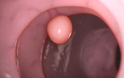 Bệnh polyp đại trực tràng là gì? Những điều cần biết về polyp đại trực tràng