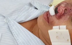 Chuyên gia bệnh truyền nhiễm nói gì về bệnh do vi khuẩn ăn mòn cơ thể 