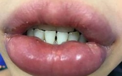 Nữ bệnh nhân biến dạng môi sau khi làm đẹp ở thẩm mỹ viện