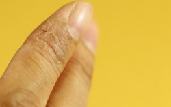 Bảo vệ làn da trong mùa lạnh