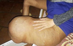 Bác sĩ BV Việt Đức cũng không chẩn được bệnh chân voi này