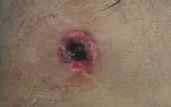 Nghịch súng tự chế, bé trai 3 tuổi bị đạn xuyên dập não