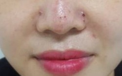 Tiêm chất làm đầy tại spa, nữ bệnh nhân nhập viện gấp vì biến chứng