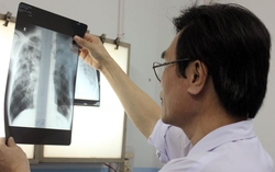 Rơi vào “tầm ngắm” của lao phổi