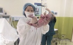 Trẻ sơ sinh chào đời nặng như bé 2-3 tháng tuổi