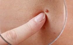 Đi khám nốt ruồi phát hiện bị ung thư hắc tố