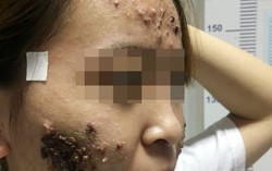9x Hải Phòng gặp họa vì trị mụn trứng cá ở phòng khám tư