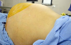Tưởng béo bụng, đi khám phát hiện khối u buồng trứng nặng 6kg