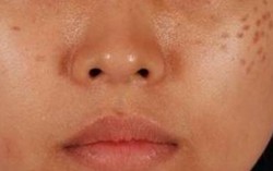 Trị nám kiểu "vái tứ phương" khiến da càng xấu, càng sạm