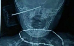Té ngã, bé gái 11 tháng bị đồ chơi sắc nhọn cắm vào đầu