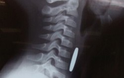 Bé 6 tuổi gặp nguy vì đồng xu bất ngờ rơi vào cổ họng 