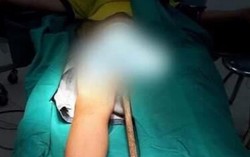 Nhảy từ bờ tường, bé 6 tuổi bị thanh sắt đâm từ bộ phận sinh dục lên bụng