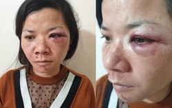 Xử phạt hành chính người chồng đánh vợ dã man tối mùng 2 Tết