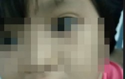 Bé gái 6 tuổi bị cha dượng chích thuốc lá khắp người đã được ông bà ngoại đón về