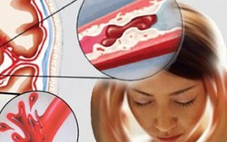 Đột quị do nhồi máu cơ tim ở người dưới 30 tuổi đang tăng
