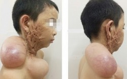 Tạo hình thành công khuôn mặt bé bị bỏng nặng