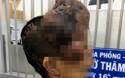 ‘Gỡ’ khối u sợi thần kinh vùng mặt 1,7kg cho bệnh nhân nữ