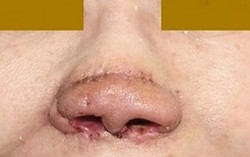 Dùng vành tai tái tạo cánh mũi cho nữ bệnh nhân