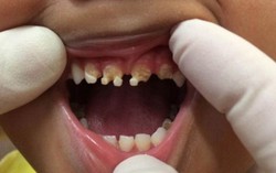 Một lon nước ngọt nạp đường đủ cho hai ngày