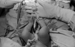 Cứu kịp thời trường hợp suy thai cấp do dây rốn thắt nút hiếm gặp