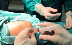 Điều trị thoái hóa khớp gối bằng tế bào gốc lấy từ mô mỡ