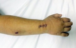 Chơi trốn tìm với bạn, bé 5 tuổi bị trúng đạn súng hơi