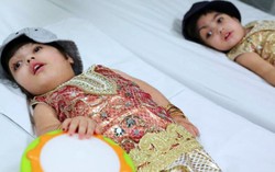 Ca mổ hơn 2 ngày tách thành công cặp đôi dính hộp sọ