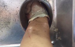 Nữ bệnh nhân nhập viện cấp cứu với bàn tay bị kẹt trong máy xay thịt