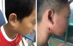 Phát hiện 3 trẻ mắc chứng bệnh vi khuẩn ăn mòn cơ thể