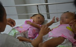 Mổ tách thành công 2 bé gái dính nhau phức tạp