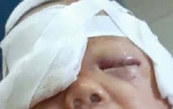 Bé 20 tháng tuổi bị chó nhà nuôi cắn nát mặt