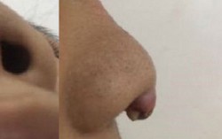Biến chứng do thẩm mỹ tăng cao dịp cuối năm