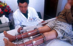 Phẫu thuật kéo chân: 40 triệu 1 ca lên đời tầm vóc