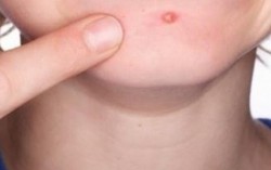 Dưỡng chất trị mụn ở cằm