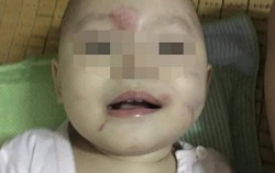 Hải Phòng: Bé 14 tháng tuổi mặt bầm tím, cô giáo bảo do bạn… cắn