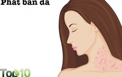 Dấu hiệu cảnh báo ngộ độc nấm mốc mà bạn nên biết