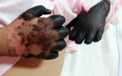 Mắc bệnh Than, bé 3 tuổi phải tháo khớp tay chân