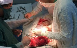 U xơ tử cung hơn 6kg do tự dùng thuốc