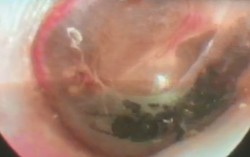 Bé gái 10 tuổi bị kiến bò vào tai xuyên thủng màng nhĩ gây đau dữ dội